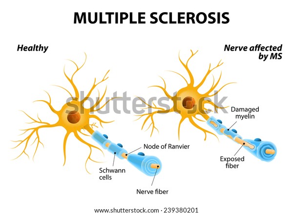 Multiple\
sclerosis or MS. autoimmune disease. the nerves of the brain and\
spinal cord are damaged by one\'s own immune system. resulting in\
loss of muscle control, vision and balance.\
