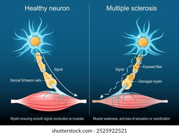 Esclerosis múltiple. Mielina que asegura la conducción suave de la señal a los músculos en la neurona sana. Neurona de esclerosis múltiple con mielina dañada, fibra expuesta. Debilidad muscular y pérdida de la sensibilidad