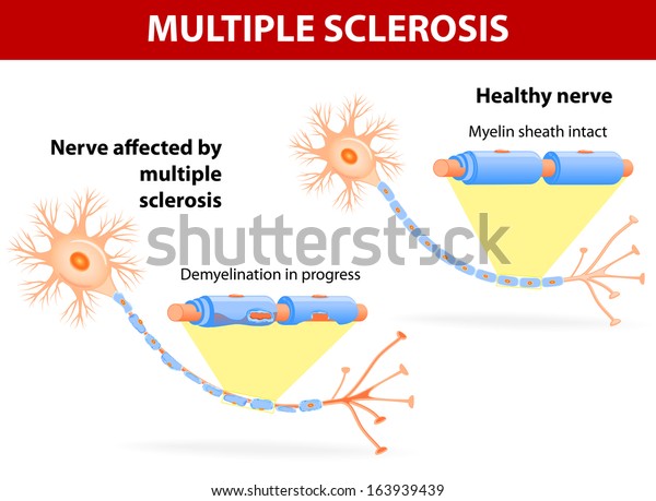 Multiple Sclerosis Specific Immune System Malfunction Stock Vector