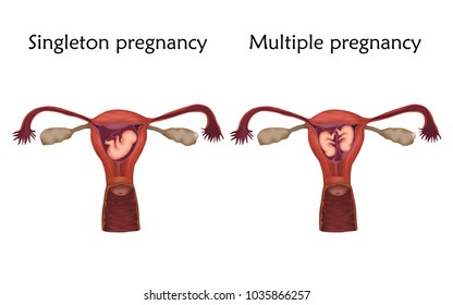 Multiple And Singleton Pregnancy, Twins, Embryo, Fetus In Uterus, Placenta, Umbilical Cord. Vector Medical Illustration. Colored Image, White Background.