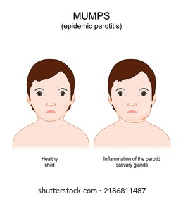 Mumps. Epidemic parotitis. viral disease caused by the mumps virus. Comparison and difference between Healthy child and boy with Inflammation of the parotid salivary glands. vector illustration