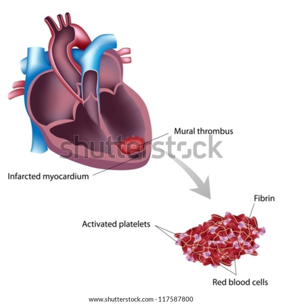 Mural Thrombus After Heart Attack Stock Vector (Royalty Free) 117587800