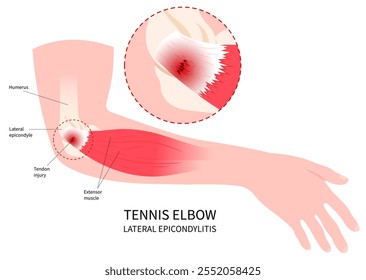 Paralisia do braço e da mão com lesão do nervo muscular na anatomia