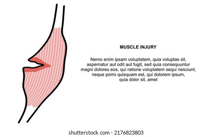 Muskelverletzungsbanner. Banner für Muskelschmerzen. Pulsierter Hamstring einzeln auf weißem Hintergrund. Hamstring Strain Symbol.  Muskelvektorgrafik