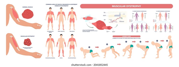 Muscle myopathy gene DNA cell damage Becker type Limb Girdle x linked Distal Emery loss Lack fibres tissue biceps arm spine weaken gait lumbar calf sign Gower lower exam fatigue Physical genetic stand
