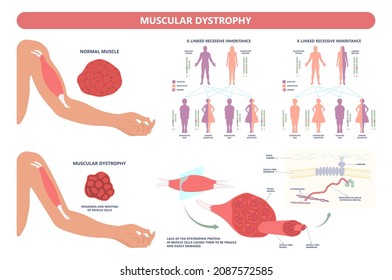 Muscle myopathy gene DNA cell damage Becker type Limb Girdle x linked Distal Emery loss Lack fibres tissue biceps arm spine weaken gait lumbar calf sign Gower lower exam fatigue Physical genetic stand
