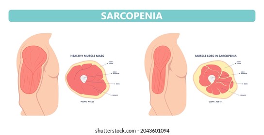 Muscle pain nerve waste injury arm leg lack diet limb nutrition body activity lateral Guillain Barre loss tissue Atrophied poor genetic older frailty Spinal gene mass Polio cord Aging adults body BMI