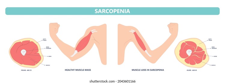 Muscle pain nerve waste injury arm leg lack diet limb nutrition body activity lateral Guillain Barre loss tissue Atrophied poor genetic older frailty Spinal gene mass Polio cord Aging adults body BMI