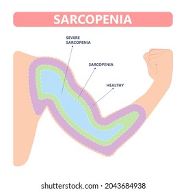 Muscle pain nerve waste injury arm leg lack diet limb nutrition body activity lateral Guillain Barre loss tissue Atrophied poor genetic older frailty Spinal gene mass Polio cord Aging adults body BMI