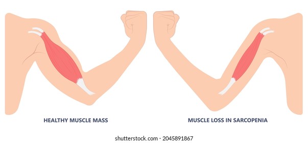 Muscle Pain Nerve Waste Injury Arm Leg Lack Diet Limb Nutrition Body Activity Lateral Guillain Barre Loss Tissue Atrophied Poor Genetic Older Frailty Spinal Gene Mass Polio Cord Aging Adults Body BMI