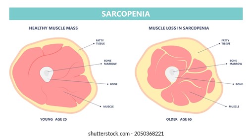 Muscle pain nerve waste injury arm leg lack diet limb nutrition body activity lateral Guillain Barre loss tissue Atrophied poor genetic older frailty Spinal gene mass Polio cord Aging adults body BMI