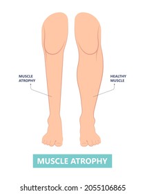 Muscle pain nerve waste injury arm leg lack diet limb nutrition body activity lateral Guillain Barre loss tissue Atrophied poor genetic older frailty Spinal gene mass Polio cord Aging adults body BMI