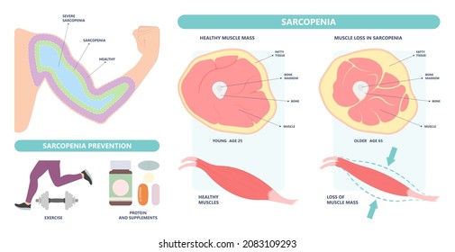 Muscle pain nerve waste injury arm leg lack diet limb nutrition body activity lateral Guillain Barre loss tissue Atrophied poor genetic older frailty Spinal gene mass Polio cord Aging adults body BMI