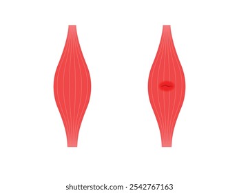 Ruptura muscular. Ilustração de músculo normal e distendido