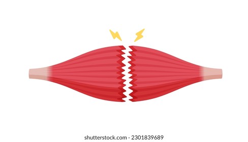 Muscle rupture vector illustration ( complete tear )