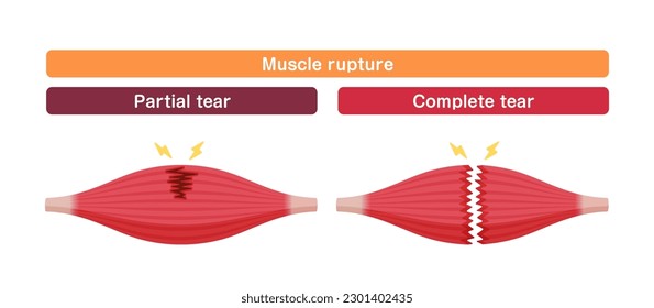 Muscle rupture vector illustration (partial and complete tears )