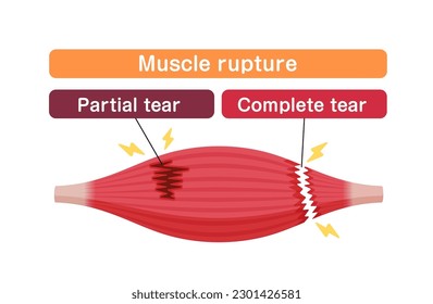 Ilustración vectorial de ruptura muscular (lágrimas parciales y completas)