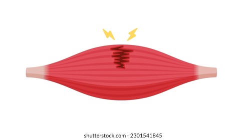 Muscle rupture vector illustration (partial tear )