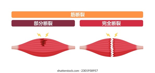 Muscle rupture vector illustration (partial and complete tears ). Translation: Muscle rupture , partial, complete.