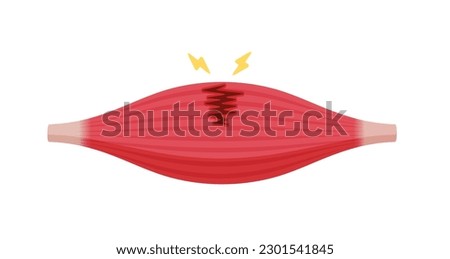 Muscle rupture vector illustration (partial tear )
