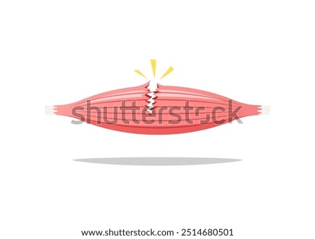 Muscle rupture vector isolated on white background.