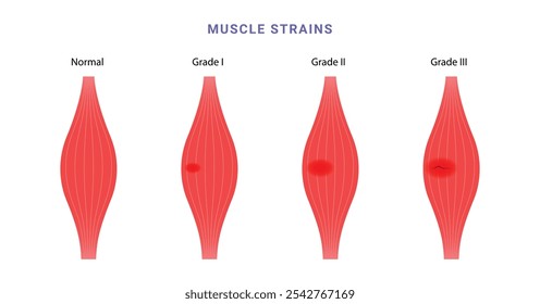 Muscle strain grading science diagram