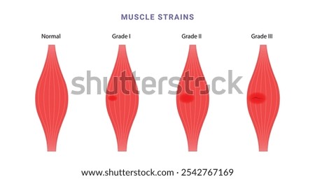 Muscle strain grading science diagram