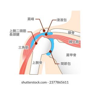 Muscles and anatomical structures around the shoulder joint :Translate. supraspinatus muscle
supraspinatus calcification ,Calcific, Tendinopathy of the Shoulder,Inflamed bursa