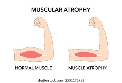 Atrofia muscular comparada a um diagrama esquemático saudável. Fraqueza muscular anormal e ilustração de vetor de incapacidade de movimento normal.