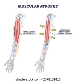 Muscular Atrophy Or SMA Disorder Example Compared To Healthy Outline Diagram. Labeled Educational Medical Illness With Abnormal Muscle Weakness And Normal Movement Disability Vector Illustration.
