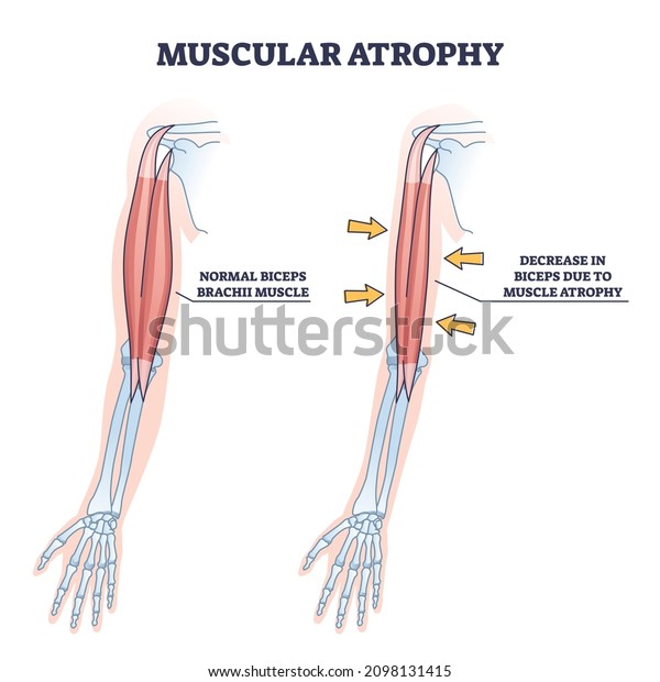 Muscular atrophy or SMA disorder example\
compared to healthy outline diagram. Labeled educational medical\
illness with abnormal muscle weakness and normal movement\
disability vector\
illustration.