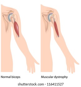 Muscular Dystrophy