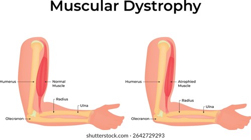Distrofia Muscular Braço Atrofia Muscular Design Vetor Ilustração Diagrama