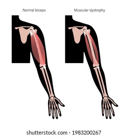 Muscular dystrophy concept. Disease in human arm muscles. Muscular system and bones in male silhouette. Anatomical poster of biceps brachioradialis and brachialis. Medical vector illustration of hand.