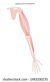 Muscular dystrophy concept. Disease in human arm muscles. Muscular system and bones in male silhouette. Anatomical poster of biceps brachioradialis and brachialis. Medical vector illustration of hand.