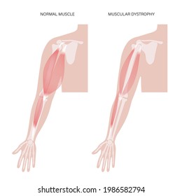 Konzept der Muskeldystrophie. Erkrankungen der Muskeln des menschlichen Armes. Muskelsystem und Knochen in männlicher Silhouette. Anatomisches Poster von Biceps brachioradialis und brachialis. Medizinische Vektorgrafik der Hand.