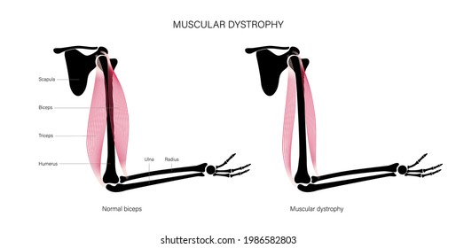 Muscular dystrophy concept. Disease in human arm muscles. Muscular system and bones in male silhouette. Anatomical poster of biceps brachioradialis and brachialis. Medical vector illustration of hand.