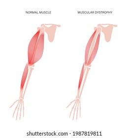 Muscular dystrophy concept. Disease in human arm muscles. Muscular system and bones in male silhouette. Anatomical poster of biceps brachioradialis and brachialis. Medical vector illustration of hand.
