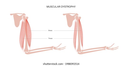 Konzept der Muskeldystrophie. Erkrankungen der Muskeln des menschlichen Armes. Muskelsystem und Knochen in männlicher Silhouette. Anatomisches Poster von Biceps brachioradialis und brachialis. Medizinische Vektorgrafik der Hand.