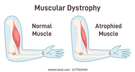 Muscular dystrophy. Healthy muscle versus atrophied one. Anatomical structure of the healthy human muscle and muscle with duchenne disorder. Flat vector illustration