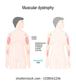 Muscular dystrophy is a muscle diseases that results in weakening and breakdown of skeletal muscles over time. Vector illustration for educational, science and medical use