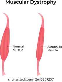 Distrofia Muscular Normal vs Músculo Atrofiado	