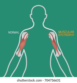 Muscular dystrophy vector illustration