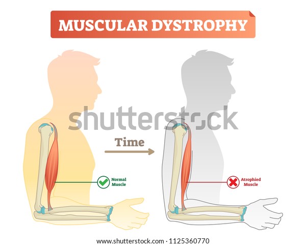 筋ジストロフィーベクターイラスト 平常筋と健康筋を比較したとき
