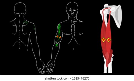 Musculus biceps brachii. Biceps trigger points and pain