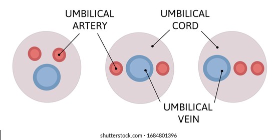 Mutual position of the umbilical cord vessels. two umbilical arteries and one umbilical vien are different located inside the umbilical cord. Colored medical vector illustration isolated on white 