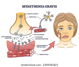 Myasthenia gravis as autoimmune, neuromuscular disease outline diagram. Labeled educational medical scheme with skeletal muscles weakness symptoms vector illustration. Anatomical illness explanation.