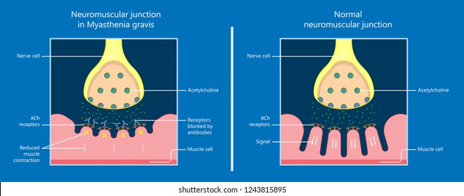 Diagnóstico del tratamiento de la enfermedad de Myasthenia gravis (MG) Prueba de diagnóstico de la parálisis de Bell