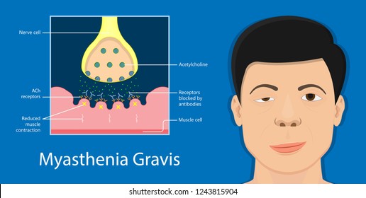 Myasthenia gravis (MG) disease treatment diagnosis test bell palsy exam nerve stimulation weakness problem muscular motor cubital guillain barre peripheral neuropathy neuron polymyositis injury