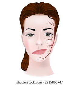 Myasthenia. Woman's twisted face. Damage to the triadic nerve and weakness of facial muscles. Dropped eyelid. Vector illustration